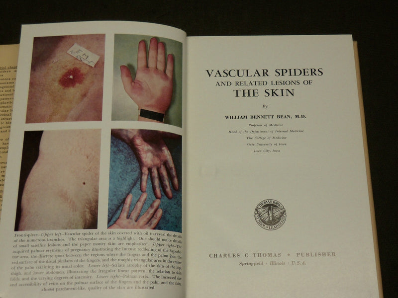 1958 VASCULAR SPIDERS AND RELATED LESIONS BOOK BY WILLIAM BENNETT BEAN - KD 6263