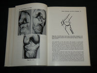1983 CHONDROMALACIA OF THE PATELLA HARDCOVER BOOK BY PICKETT & RADIN - KD 7055