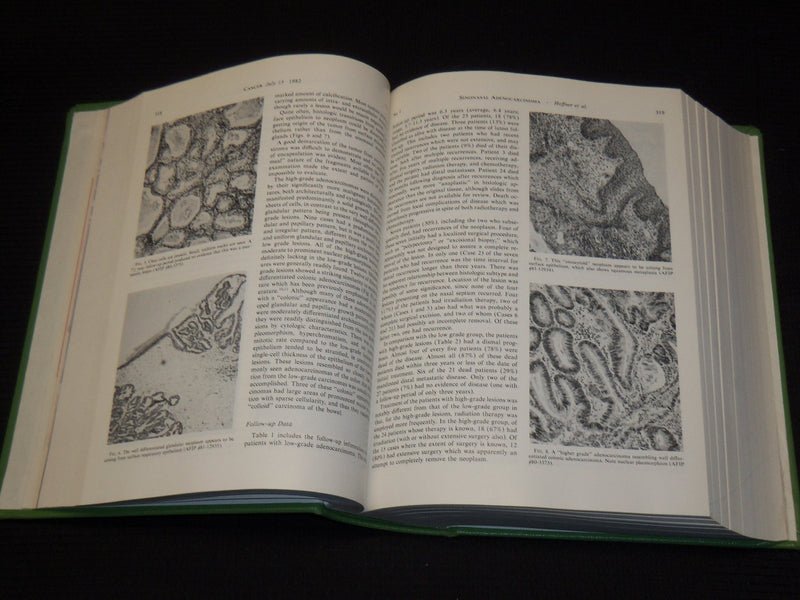 1982-1988 CANCER JOURNAL MAGAZINE BOUND VOLUMES LOT OF 6 - KD 1I