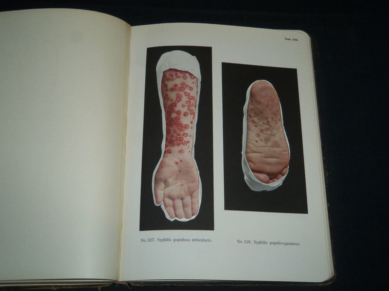 1913 PORTFOLIO OF DERMOCHROMES BY JEROME KINGSBURY VOLUMES 1-3 - KD 986