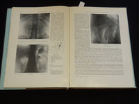 1957 RETRO PNEUMOPERITONEUM UND PPNEUMOMEDIASTINUM VON UMBERTO COCCHI - KD 5981J