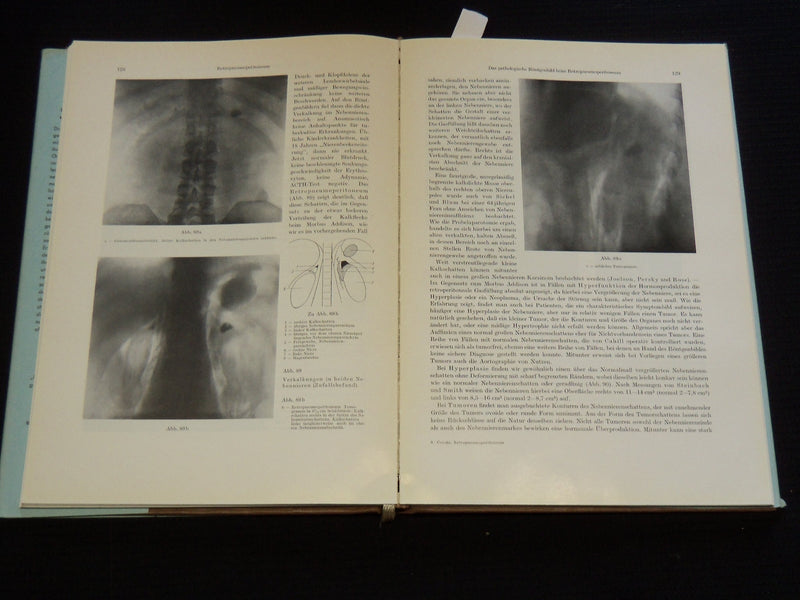 1957 RETRO PNEUMOPERITONEUM UND PPNEUMOMEDIASTINUM VON UMBERTO COCCHI - KD 5981J