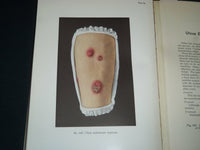 1913 PORTFOLIO OF DERMOCHROMES BY JEROME KINGSBURY VOLUMES 1-3 - KD 986
