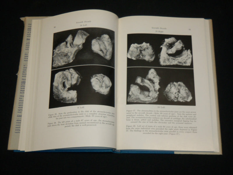 1957 DEGENERATIVE CHANGES IN THE STERNOCLAVICULAR JOINTS BOOK DEPALMA - KD 6362