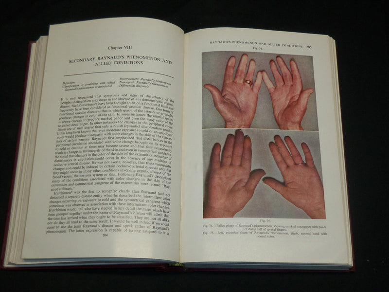 1947 PERIPHERAL VASCULAR DISEASES BOOK BY EDGAR N. ALLEN M. D. - KD 2766A