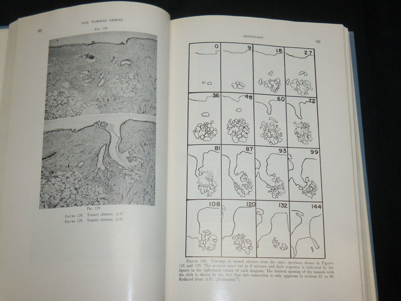 1961 THE CERVIX UTERI AND ITS DISEASES BOOK BY FREDERIC FLUHMANN M. D.- KD 2761C