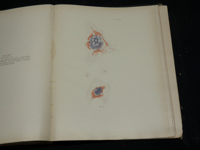 1912 STUDIES IN CANCER - PATHOLOGY BOUND VOLUME NO. 2 - 32 PLATES - KD 4500