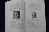 1937 JULY AMERICAN JOURNAL OF DISEASES OF CHILDREN SOFTCOVER BOOK - K 1518