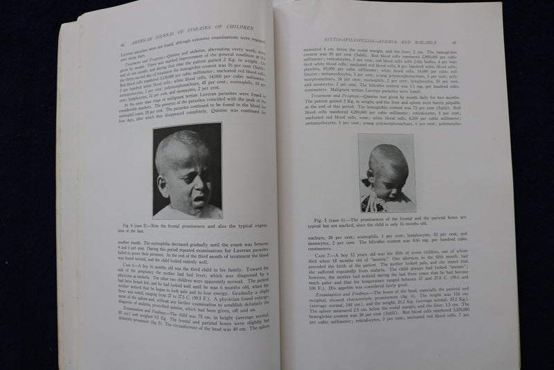 1937 JULY AMERICAN JOURNAL OF DISEASES OF CHILDREN SOFTCOVER BOOK - K 1518