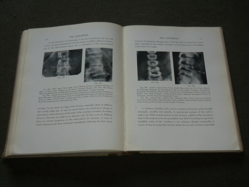 1929 ANNALS OF ROENTGENOLOGY VOLUME 8 - JAMES CASE - THE VERTEBRAE - KD 6218