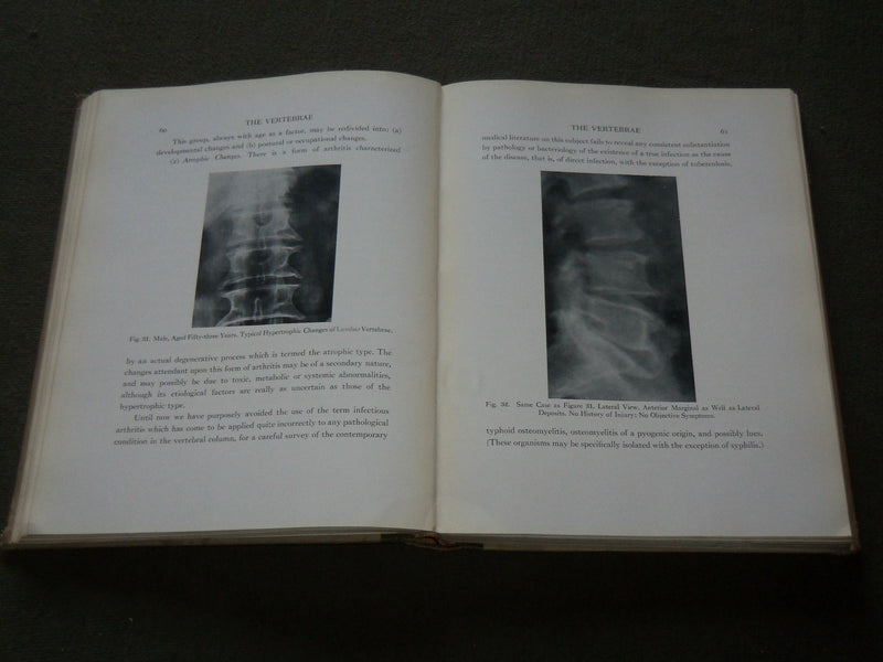 1929 ANNALS OF ROENTGENOLOGY VOLUME 8 - JAMES CASE - THE VERTEBRAE - KD 6218