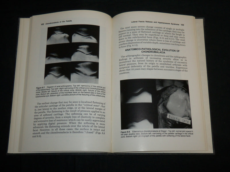 1983 CHONDROMALACIA OF THE PATELLA HARDCOVER BOOK BY PICKETT & RADIN - KD 7055