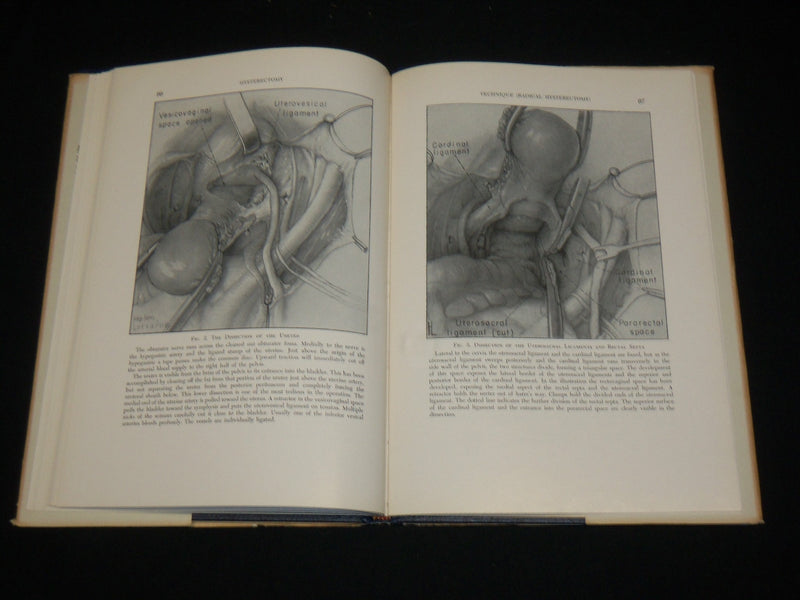 1954 HYSTERECTOMY HARDCOVER BOOK BY DR. BURCH AND DR. LAVELY - KD 6367