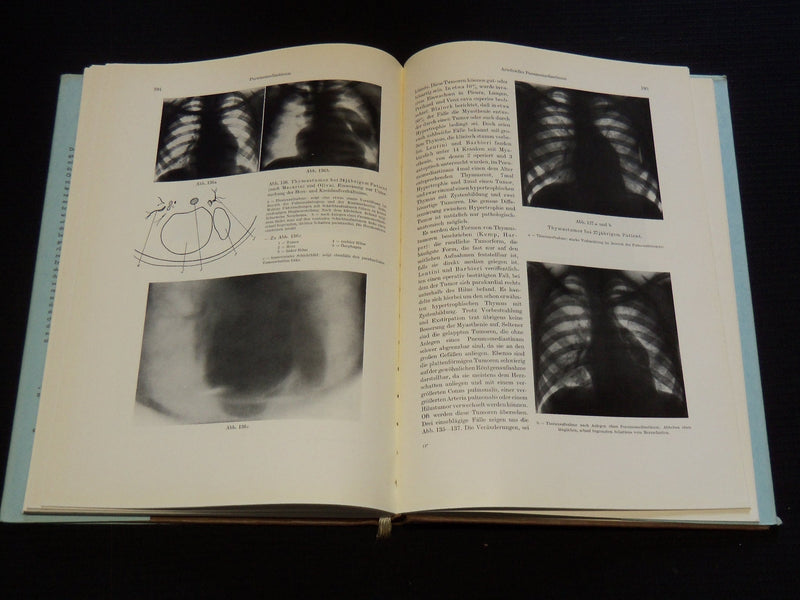 1957 RETRO PNEUMOPERITONEUM UND PPNEUMOMEDIASTINUM VON UMBERTO COCCHI - KD 5981J