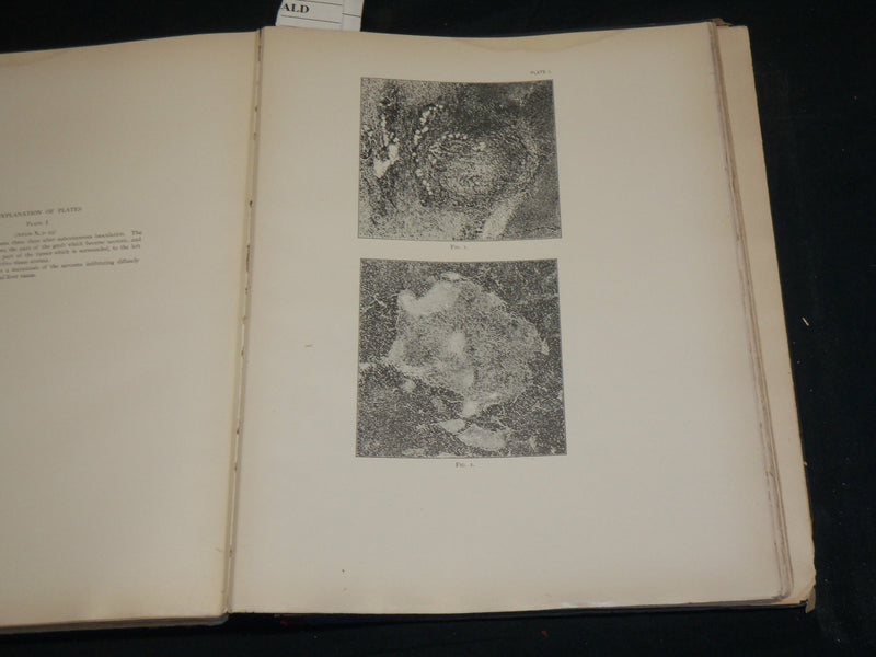1912 STUDIES IN CANCER - PATHOLOGY BOUND VOLUME NO. 2 - 32 PLATES - KD 4500