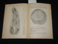 1895 ON DISEASES OF THE VERMIFORM APPENDIX HARDCOVER BOOK BY HAWKINS - KD 7359
