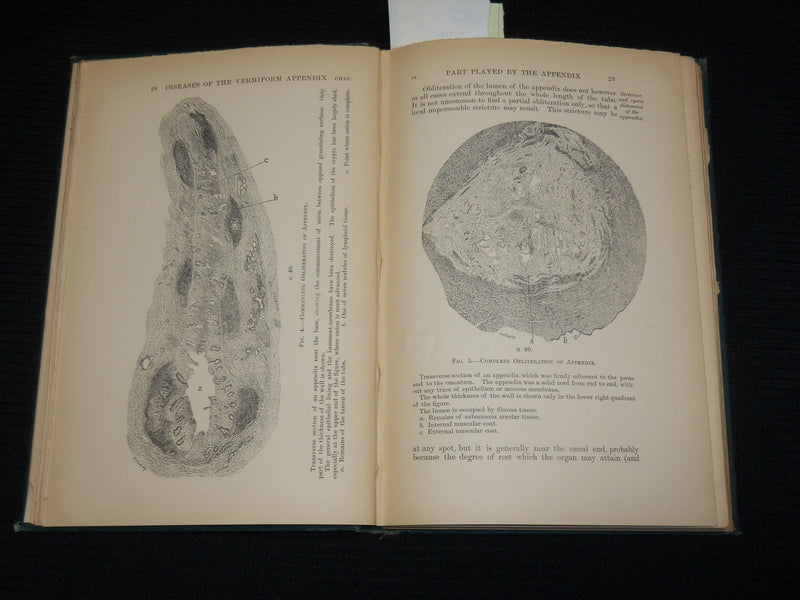 1895 ON DISEASES OF THE VERMIFORM APPENDIX HARDCOVER BOOK BY HAWKINS - KD 7359