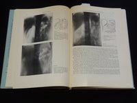 1957 RETRO PNEUMOPERITONEUM UND PPNEUMOMEDIASTINUM VON UMBERTO COCCHI - KD 5981J