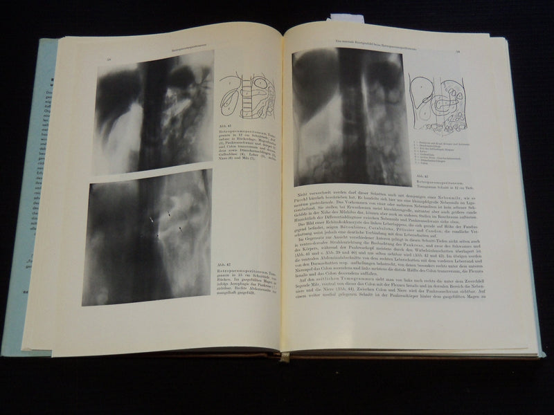 1957 RETRO PNEUMOPERITONEUM UND PPNEUMOMEDIASTINUM VON UMBERTO COCCHI - KD 5981J