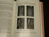 1959 DISEASES OF THE VERTEBRAL COLUMN BOOK EDITED BY NASSIM & BURROWS - KD 6052