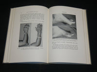 1959 GOUTY ARTHRITIS AND GOUT BOOK BY DR. WEISS & SEGALOFF - KD 2767A