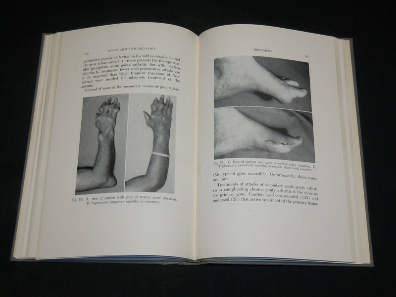 1959 GOUTY ARTHRITIS AND GOUT BOOK BY DR. WEISS & SEGALOFF - KD 2767A
