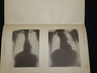 1894-1904 ARCHIV FUR LARYNGOLOGIE UND RHINOLOGIE GERMAN VOLUMES LOT OF 13 - KD 9