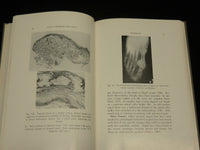 1959 GOUTY ARTHRITIS AND GOUT BOOK BY DR. WEISS & SEGALOFF - KD 2767A