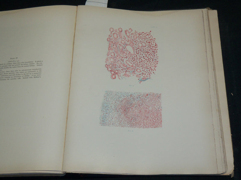 1912 STUDIES IN CANCER - PATHOLOGY BOUND VOLUME NO. 2 - 32 PLATES - KD 4500