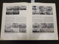 1932 SEPTEMBER SURGERY, GYNECOLOGY AND OBSTETRICS SOFTCOVER BOOK - J 5244