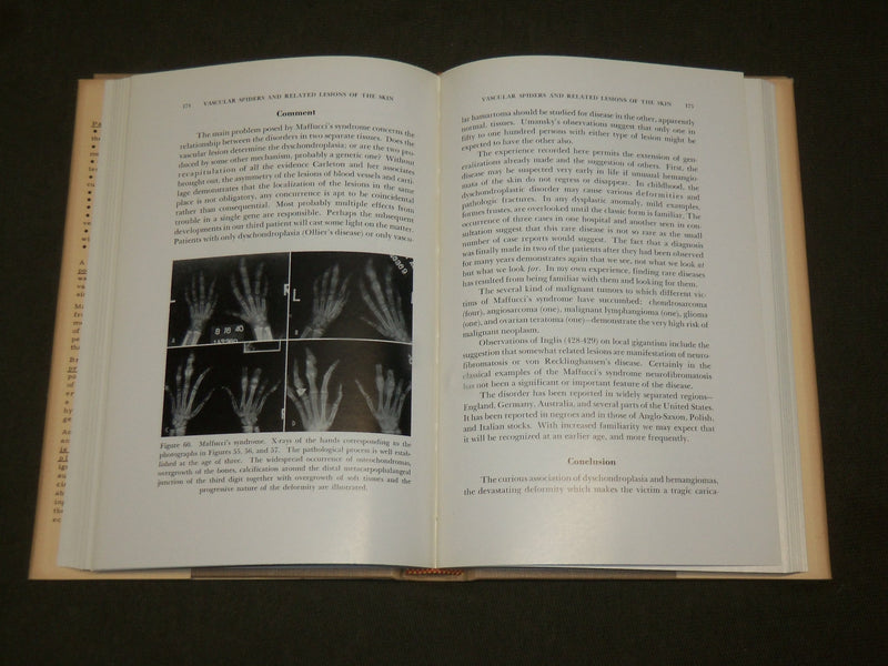 1958 VASCULAR SPIDERS AND RELATED LESIONS BOOK BY WILLIAM BENNETT BEAN - KD 6263