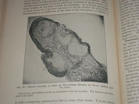 1921 GYNECOLOGICAL & OBSTETRICAL MONOGRAPHS APPLETON VOLUME LOT OF 14 - KD 2998